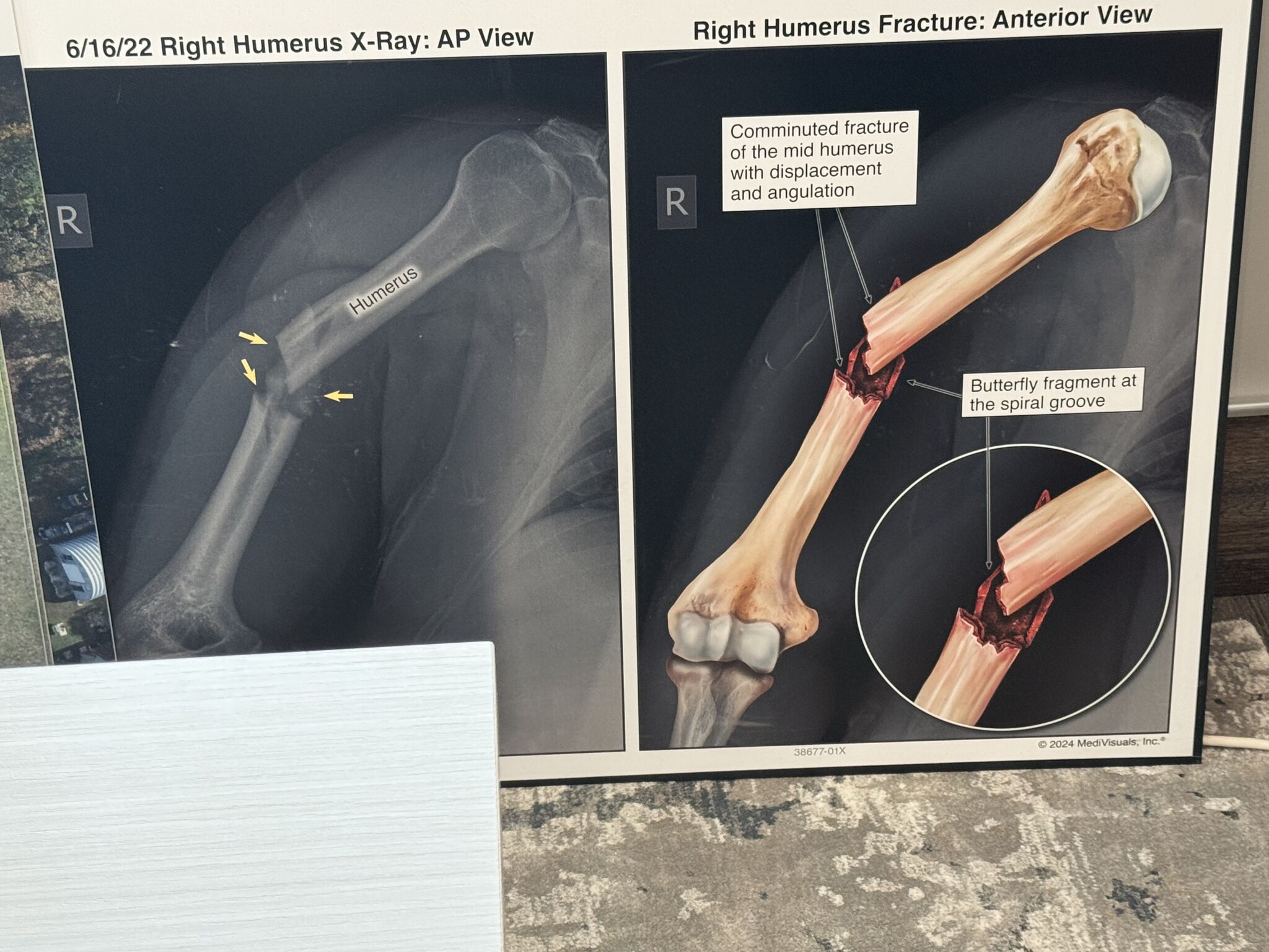 injury depiction in personal injury case